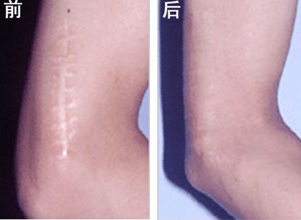 选择激光去疤痕收获甜蜜爱情